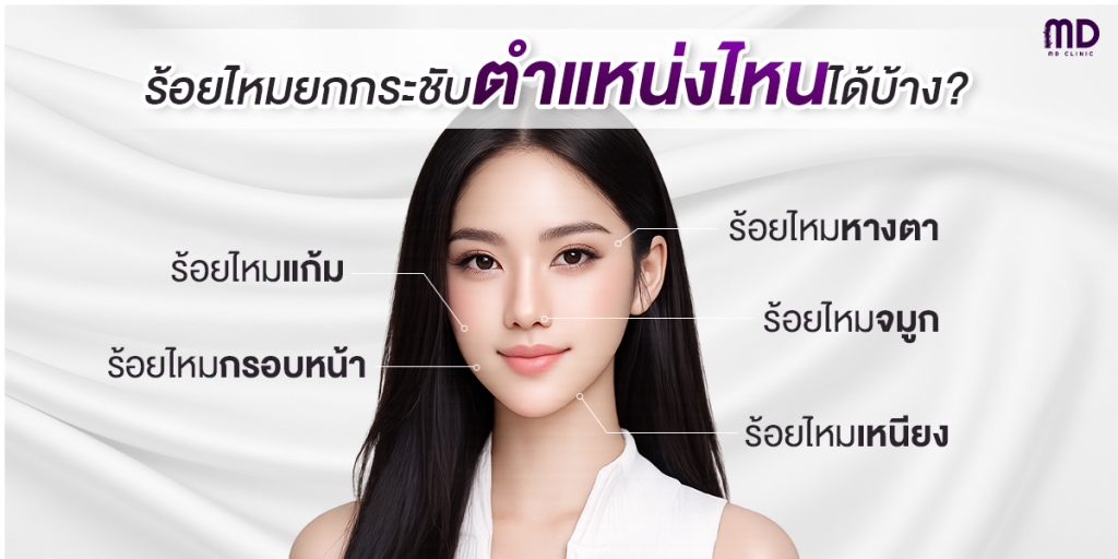 Which areas can be treated with thread lifting