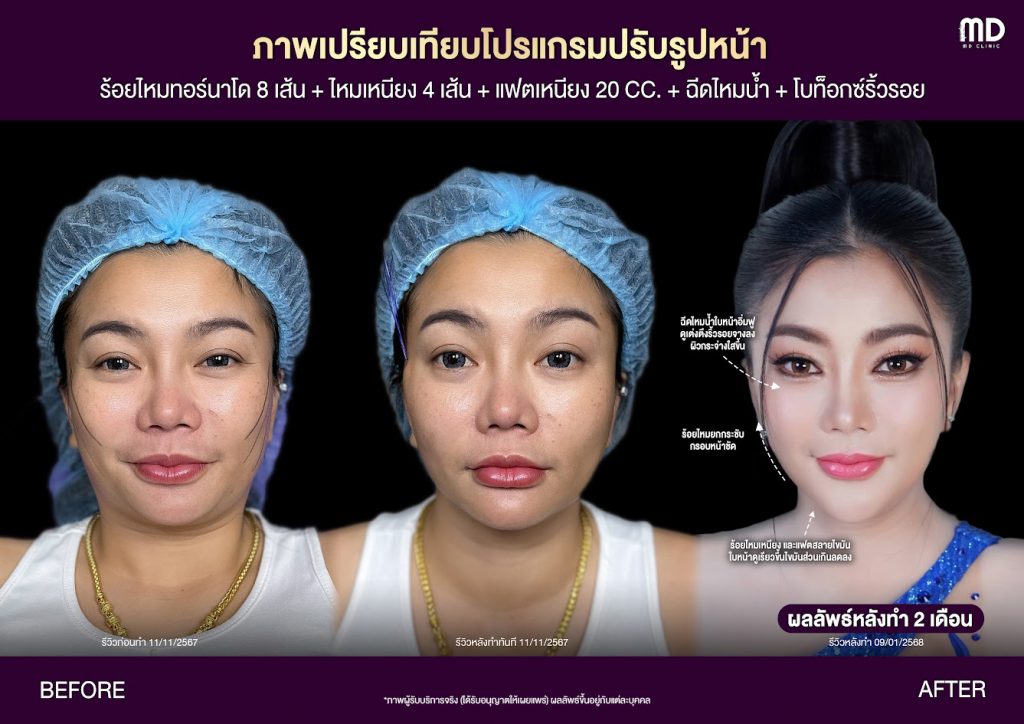 รีวิวหลังร้อยไหมทอร์นาโด2569-mdmdclinic